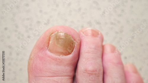 Toenails of woman with fungal infection. Brown bruise under nail of big toe. Senior woman touches injured toenail by index finge, top view