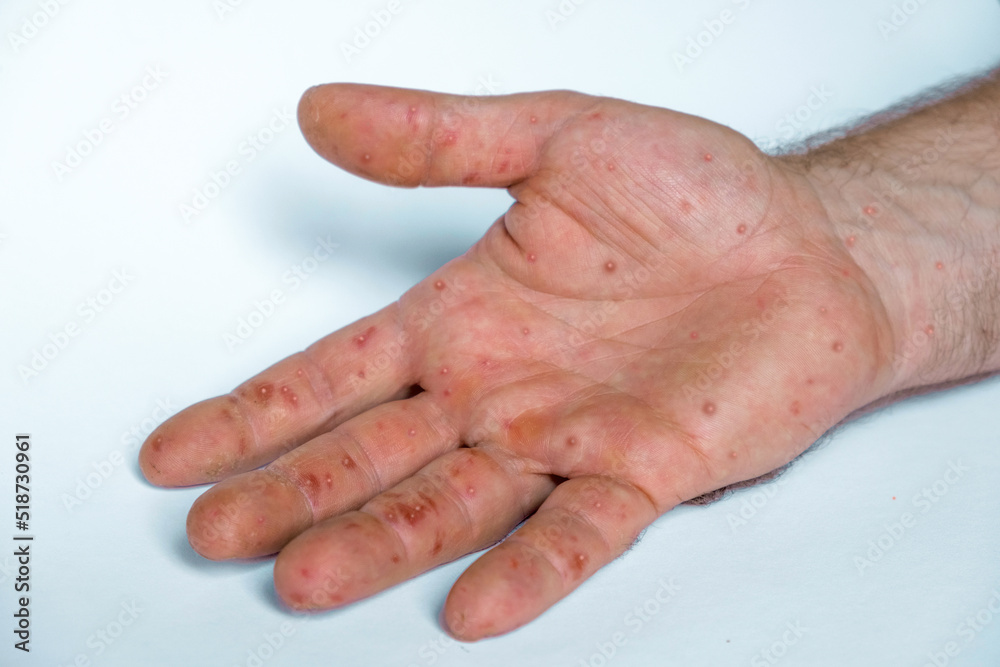 Male hands with Monkeypox rash. Patient with MonkeyPox viral disease. Close Up of Painful rash, red spots blisters on the skin. Human palm with Health problem. Banner, copy space. Allergy, dermatitis Male hands with Monkeypox rash. Patient with MonkeyPox viral disease. Close Up of Painful rash, red spots blisters on the skin. Human palm with Health problem. Banner, copy space. Allergy, dermatitis
