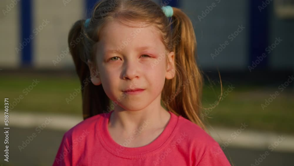 Little girl with allergy on insects bites stands on city street at sunset closeup slow motion. Child with swollen eyelid. Skin injury on summer season