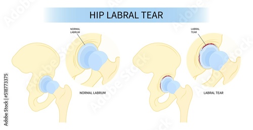 Labral cartilage of hip bone Pain and range of motion groin head tear Treat joint thigh femur injury spurs socket lesion