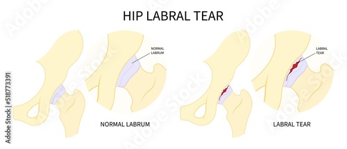 Trauma injury of hip bone Pain and range of motion groin head tear Treat joint thigh femur injury spurs socket lesion photo