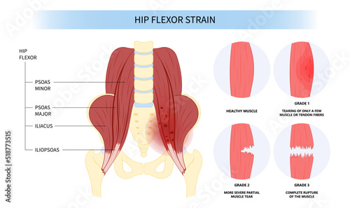 femur tendon Injury and trauma hip coxa saltans flexor stretch Pain rectus bursae Intra groin broken strain iliacus psoas torn major band Joint tear thigh tract labral tensor Muscle greater Labrum