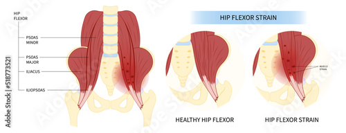 Muscle hip tendon Injury coxa saltans flexor stretch Pain rectus bursae Intra groin broken strain iliacus psoas torn major band Joint tear thigh tract labral tensor femur greater trauma Labrum photo