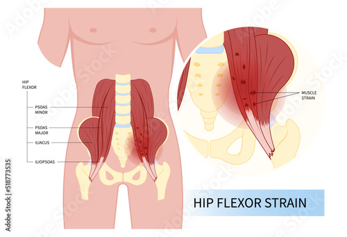 iliacus psoas torn of hip coxa saltans flexor stretch Pain rectus bursae Intra groin broken strain major band Joint tear thigh tract labral tensor femur tendon Injury Muscle greater trauma Labrum photo