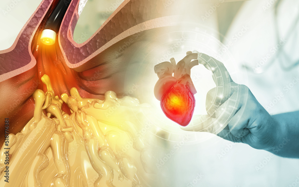 Stent and catheter for implantation into blood vessels, cholesterol