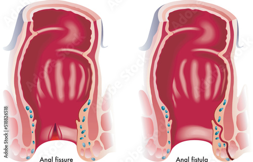 Medical illustration shows two common anal disorders, an anal fissure and an anal fistula.