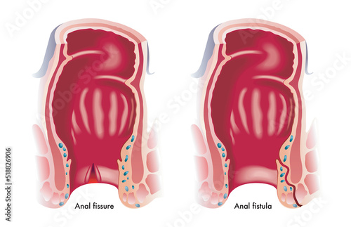 Medical illustration shows two common anal disorders, an anal fissure and an anal fistula.