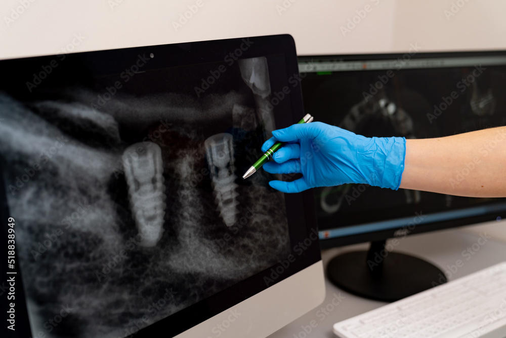 Teeth x ray professional examination. Monitor of dental healthcare. Teeth x ray professional examination. Monitor of dental healthcare.
