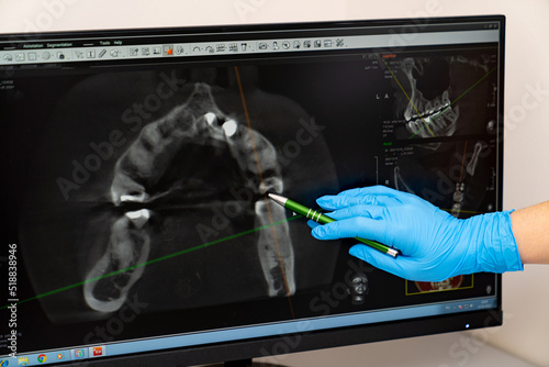 Teeth dentistry x ray examination. Modern digital radiology for stomatology. photo