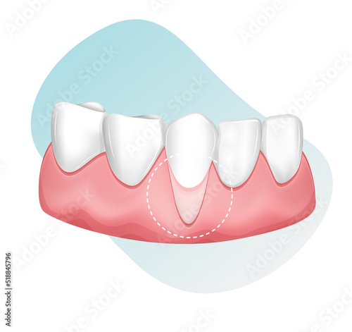 Dental Checkup for Receding Gums - stock illustration