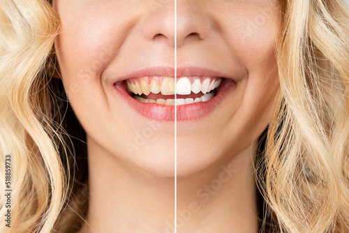 Fotografi Smiling woman before and after the teeth whitening procedure, close-up image