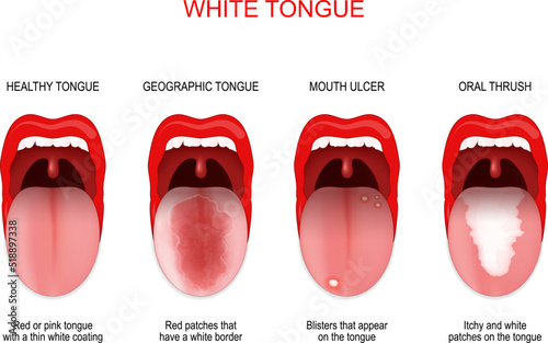 Sore or white tongue