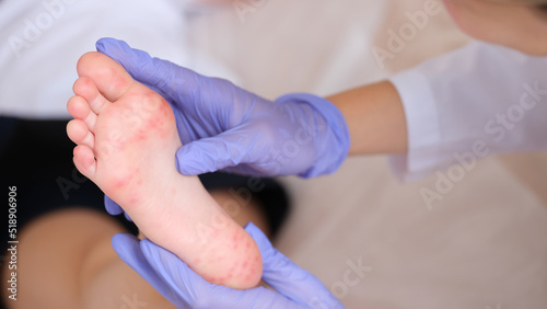 Rash with enterovirus infection of picornavirus family on feet of child photo