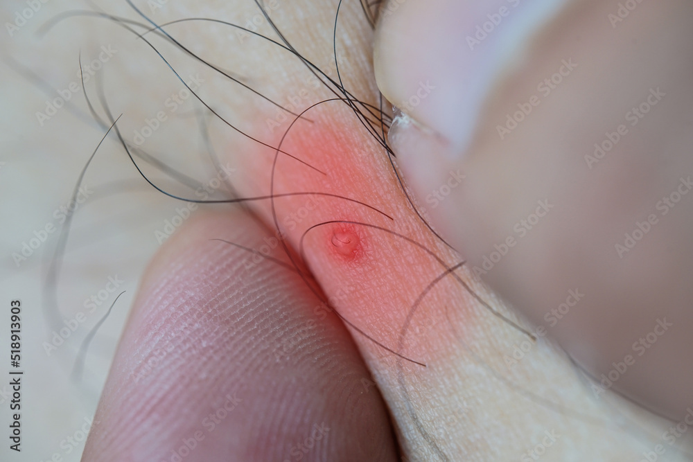 human abscess injury. Highlight a single color on the abscess. human abscess injury. Highlight a single color on the abscess.