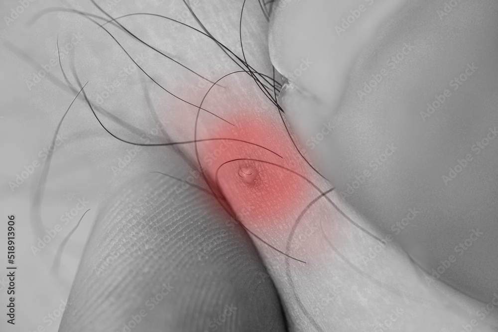 human abscess injury. Highlight a single color on the abscess. human abscess injury. Highlight a single color on the abscess.