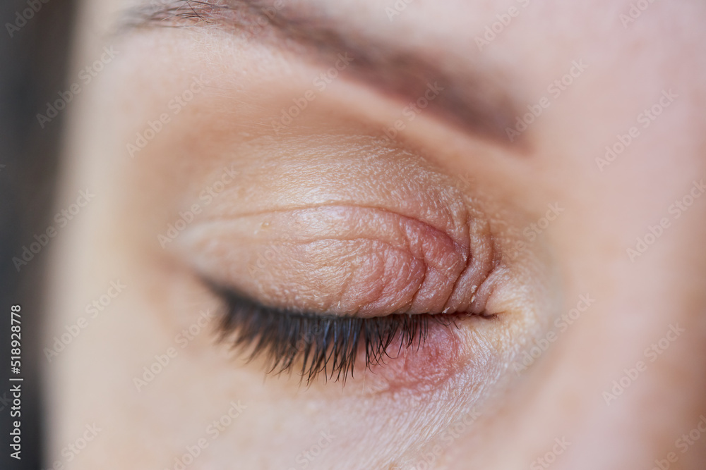 Peeling and swelling on the eyelid of the human eye - obrazy, fototapety, plakaty 