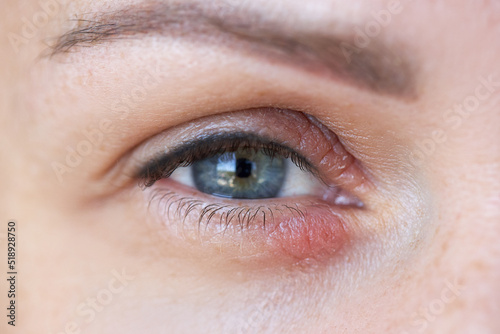 Obraz na płótnie Peeling and swelling on the eyelid of the human eye w salonie
