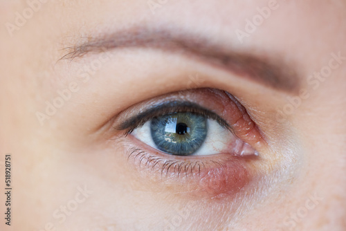 Peeling and swelling on the eyelid of the human eye photo