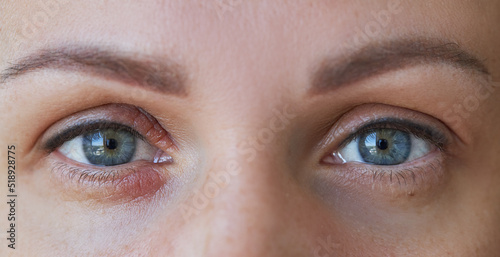 Obraz na płótnie Peeling and swelling on the eyelid of the human eye w salonie
