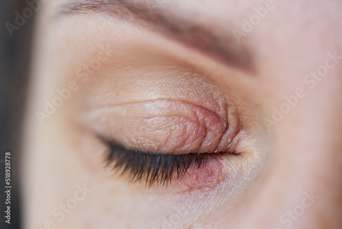 Peeling and swelling on the eyelid of the human eye photo