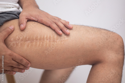 Scar caused by leg surgery photo