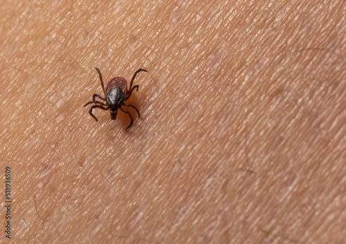 Infected female deer tick on hairy human skin. Ixodes ricinus. Parasitic mite. Acarus. Dangerous biting insect on background of epidermis detail. Disgusting carrier of infections. Tick-borne diseases