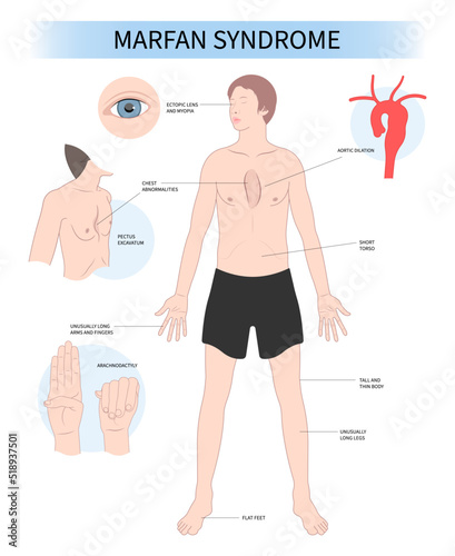 Marfan’s syndrome genetic condition disease Enlarged Heart syndrome malformation Gene Mutation