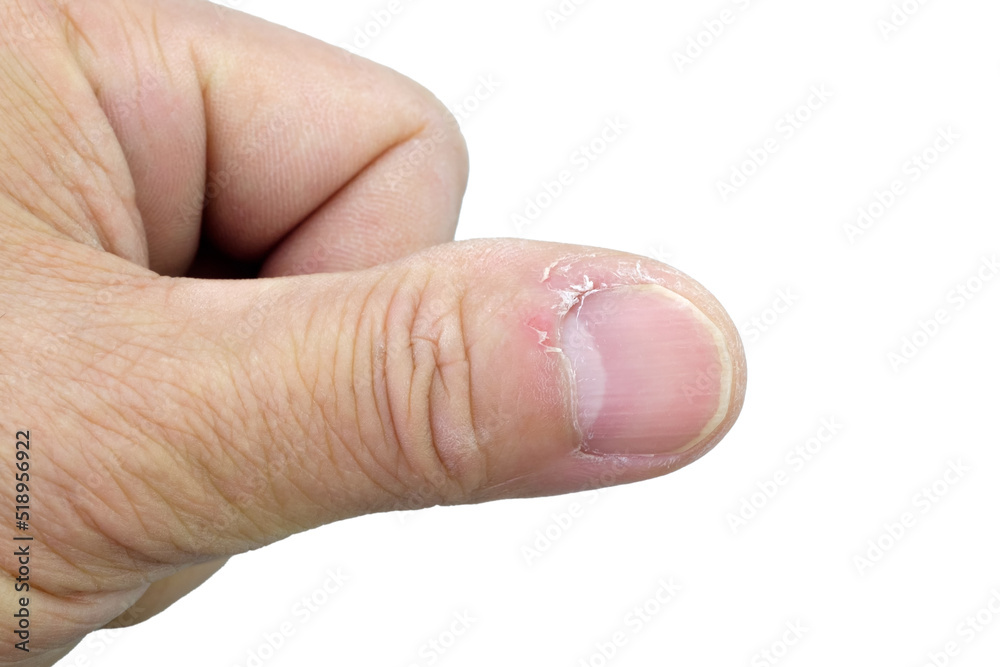 Close-up of thumb and nail with dry skin, torn and flaking off, cracked skin on cuticles, dry brittle nails. Broken fingernails inflammation. Chipped nails. Isolated on white background. Close-up of thumb and nail with dry skin, torn and flaking off, cracked skin on cuticles, dry brittle nails. Broken fingernails inflammation. Chipped nails. Isolated on white background.