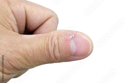 Close-up of thumb and nail with dry skin, torn and flaking off, cracked skin on cuticles, dry brittle nails. Broken fingernails inflammation. Chipped nails. Isolated on white background. photo