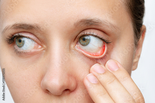 Cropped shot of a young caucasian woman showing off her red inflamed conjunctiva and dilated capillaries. Hemorrhage under the conjunctiva. Disease of retina of the eye. Conjunctivitis, keratitis photo