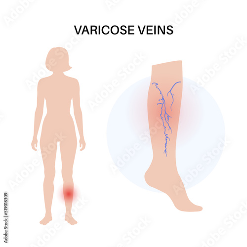 Varicose veins treatment