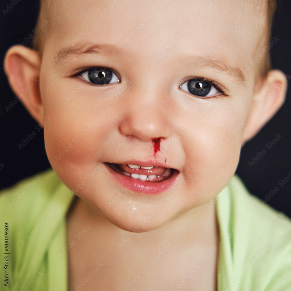 happy-toddler-baby-boy-with-a-bloody-nose-bleeding-from-the-nose-of-a