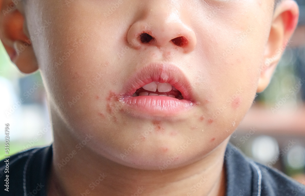 Viral Exanthem infection on Boy's face, Chicken Pox, Measles, Roseola