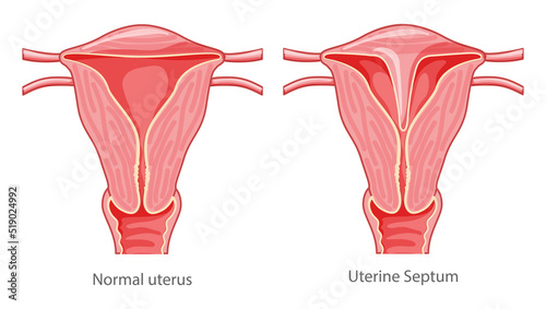 Set of Uterine septum septate uterus Female reproductive system diagram normal and with disease pain. Front view in a cut. Human anatomy internal organs flat icon Vector medical illustration isolated