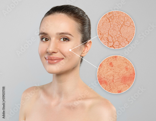 Young woman with facial dry skin problem on light grey background photo