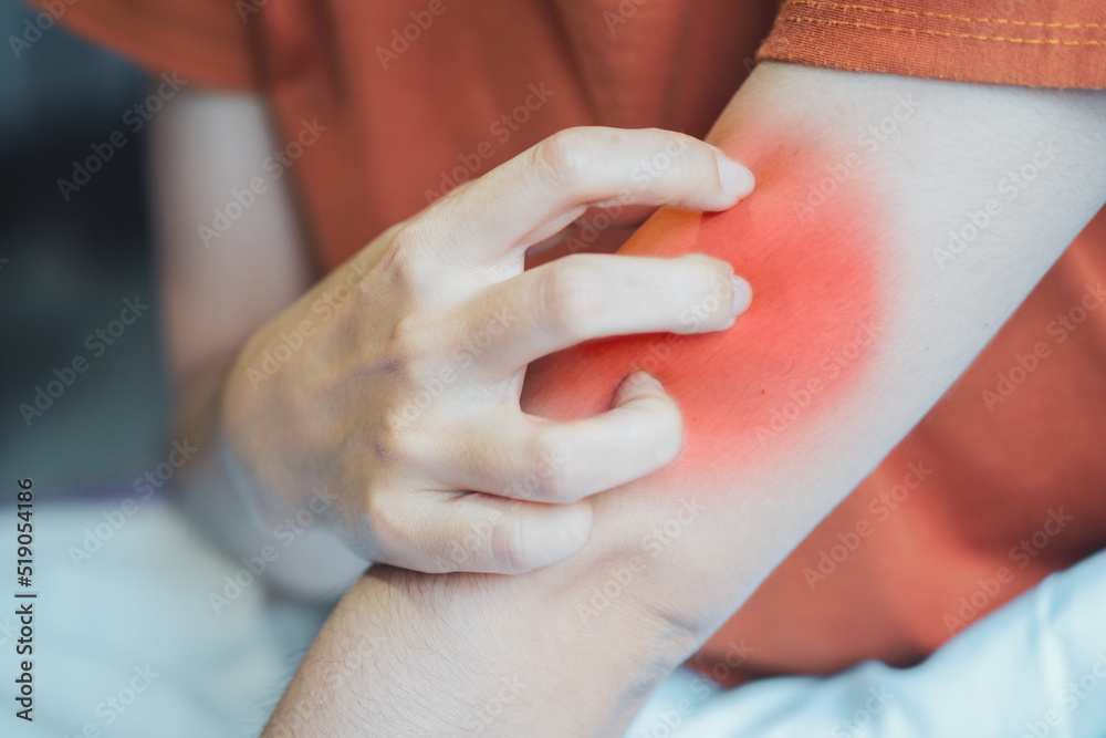 Woman scratching her arm due to irritation from insect bites. Woman scratching her arm due to irritation from insect bites.