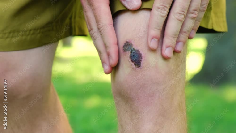 Video Stock Close up man standing outside city park touch hurt joint, suffering from bruised