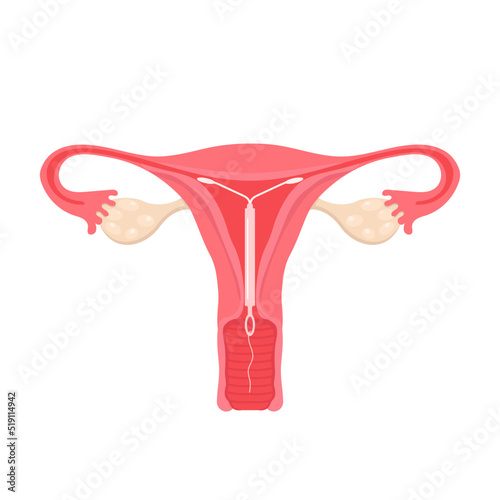 Anatomy of the female reproductive system. Female contraception. Location of the uterine coil. Women's health. Vector illustration.