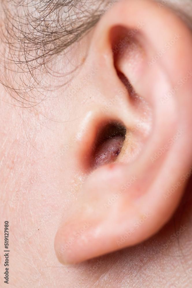 Close up of abscess Inflammation on the ear, area of suppuration. Ear furuncle. Purulent carbuncle. Treatment of abscess