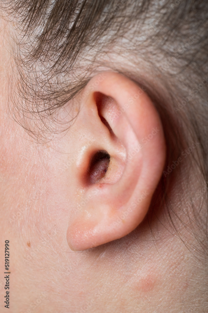 Obraz premium Close up of abscess Inflammation on the ear, area of suppuration. Ear furuncle. Purulent carbuncle. Treatment of abscess