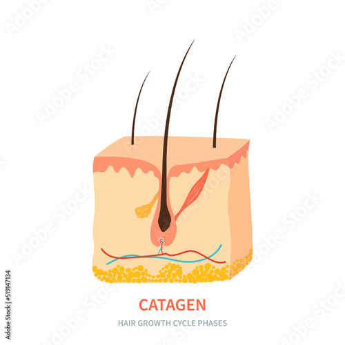 Hair follicle in catagen phase shown in skin cross-section. Hair growth cycle medical educational poster. Removal, treatment and transplantation concept. Vector illustration.