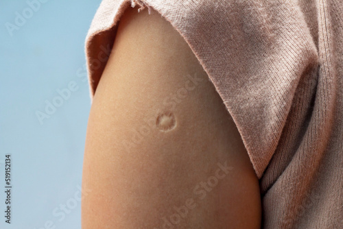Murais de parede Bacillus Calmette-Guern Vaccine,  BCG or TB vaccine scar mark at the arm of Southeast Asian women