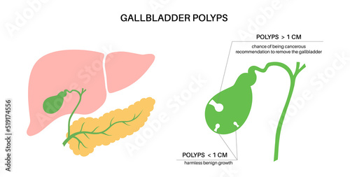 Gallbladder polyp anatomy photo