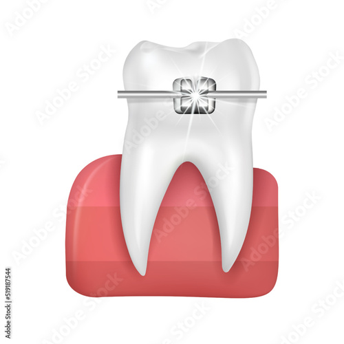 Realistic 3D vectorOrthodontic treatment style fashion beautiful blue. White teeth with metal brackets. Tooth braces isolated on a white background.