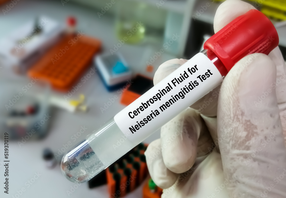 Cerebrospinal fluid or CSF sample for Neisseria meningitidis test, to