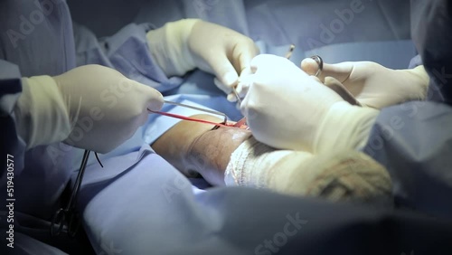 surgical center in procedure fistula for dialysis focus selective and defocused