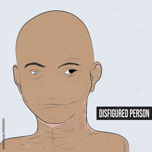 Disfigurement different appearance with effects of being burned.