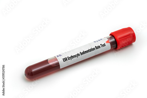 ESR Erythrocyte Sedimentation Rate Test Medical check up test tube with biological sample photo