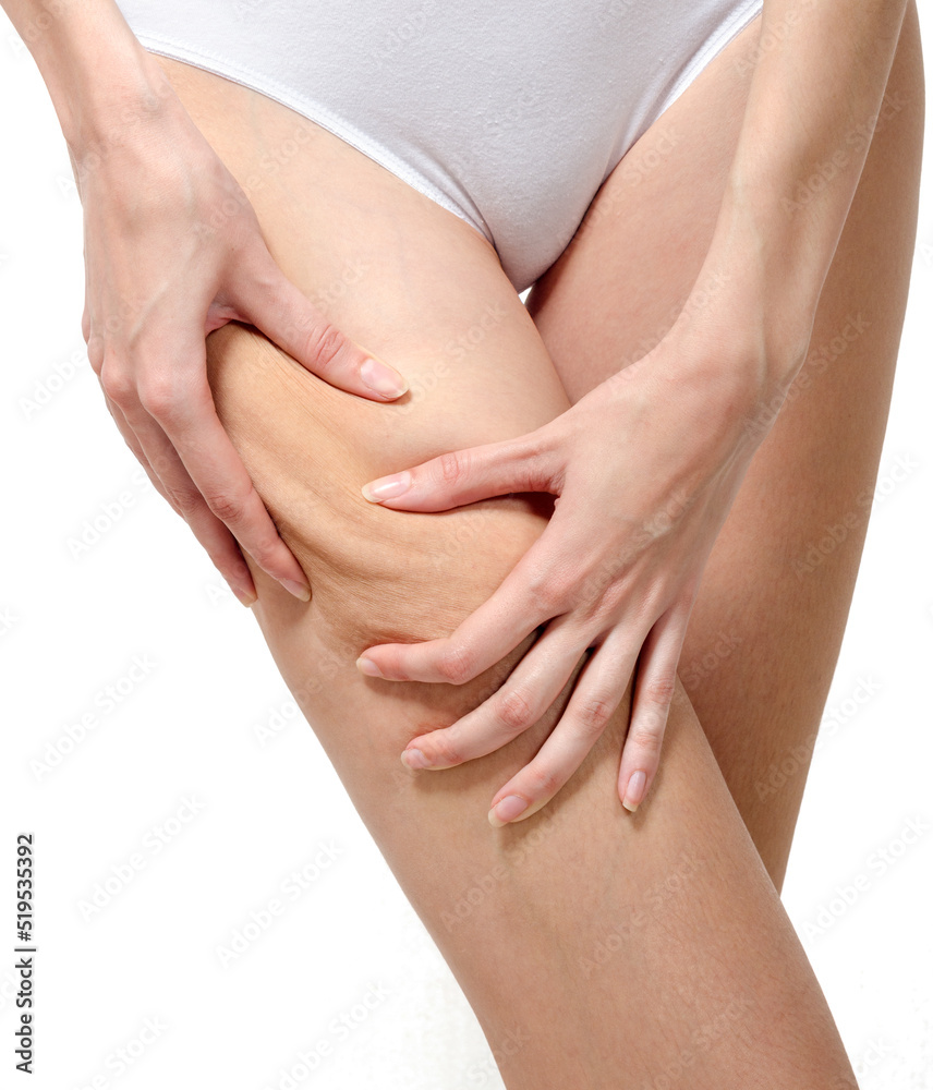 Cellulite skin on woman buttocks