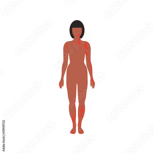 Rash on female body with tanned skin. Painful dermatitis in slender woman. Meningitis rash. Skin disease, allergy. Spots all over body. Patient with meningitis symptoms. Disease manifestation signs.
